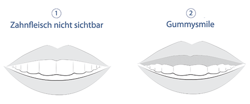 Gummy Smile Behandlung München
